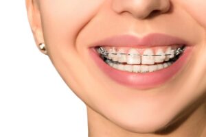 Girl smiling with ceramic clear braces on her teeth